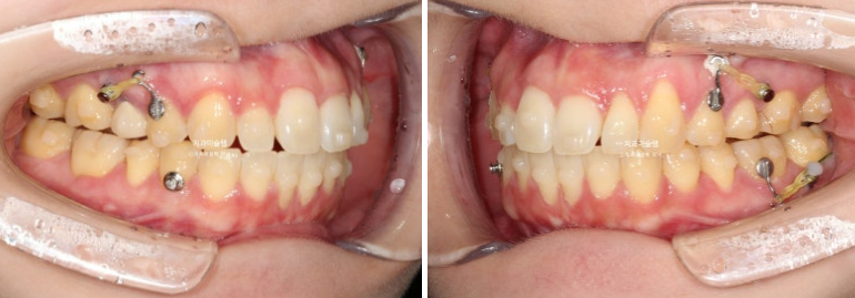 비발치 인비절라인 교정 편측 개방교합 가위교합 돌출 재교정 관련 이미지 13