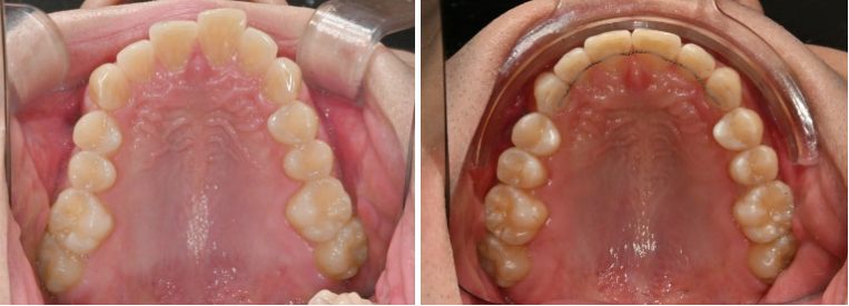 인비절라인 라이트 돌출 과개교합 중심선 교정 치간삭제 치료기간 관련 이미지 11