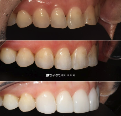 Laminate Veneers in Your 50s: Is It Possible Without Shaving Down the Teeth? | No-Prep Laminate Veneers + Real Case of Front Tooth Partial Orthodontics image 10
