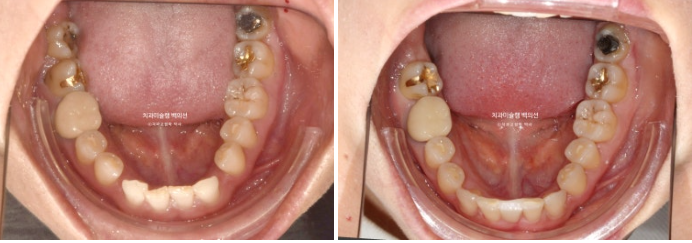 해외거주 앞니 선천적 결손 과개교합 인비절라인 라이트 브릿지 치료 관련 이미지 16