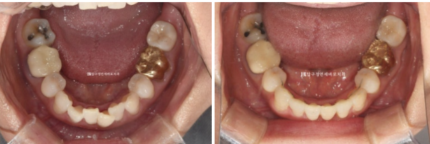 Can Invisalign Lite Work for People in Their 50s? A Real Middle-Aged Orthodontic Case Improving Butterfly Teeth and Gum Recession image 12