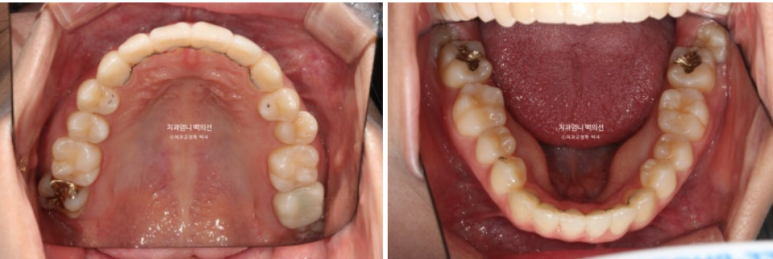 앞니 부분 교정 토끼이빨 덧니교정 ? 관련 이미지 12