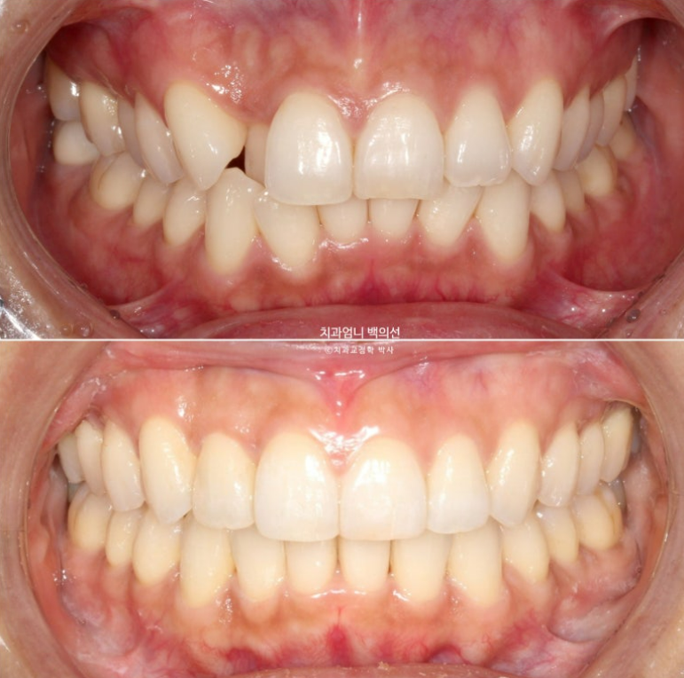 인비절라인 비발치 덧니 교정 반대교합 치료 후기 관련 이미지 16