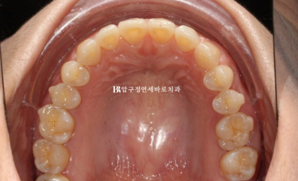 Can Gaps Between the Front Teeth Be Treated with No-Prep Veneers Alone? A Real Case Completed with Gelami After Invisalign Lite image 13