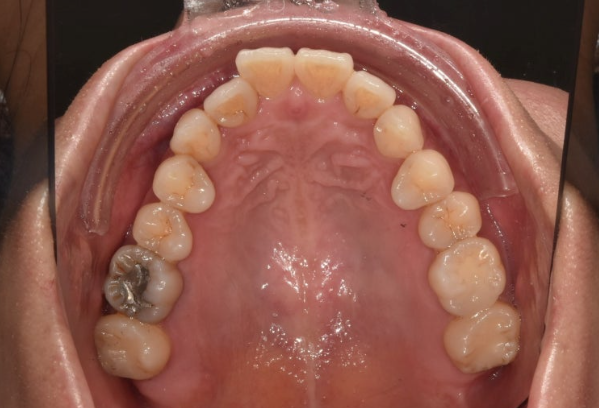 Short-Term Orthodontic Treatment Period for an Overseas Korean in Their 40s with Anterior Crossbite and Buck Teeth image 3