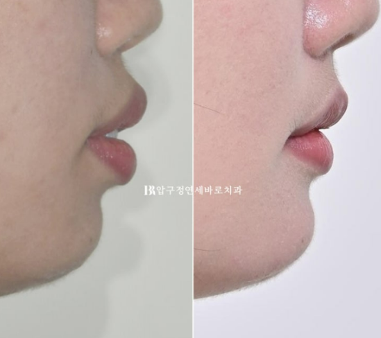 A Review of Extraction Orthodontic Treatment for Protruding Mouth | The Details of Orthodontics That Transform Buccal Corridors and Smile Lines image 16