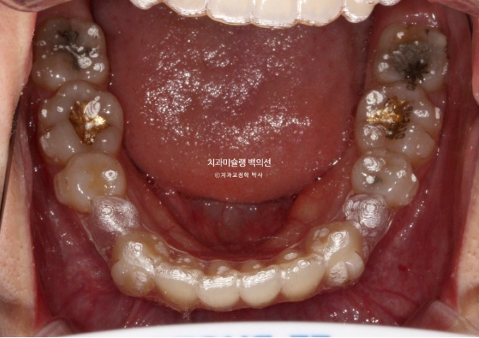 돌출입 인비절라인 발치교정 거미스마일 잇몸미소 잇몸돌출 입술부전증 무턱 재교정 관련 이미지 9
