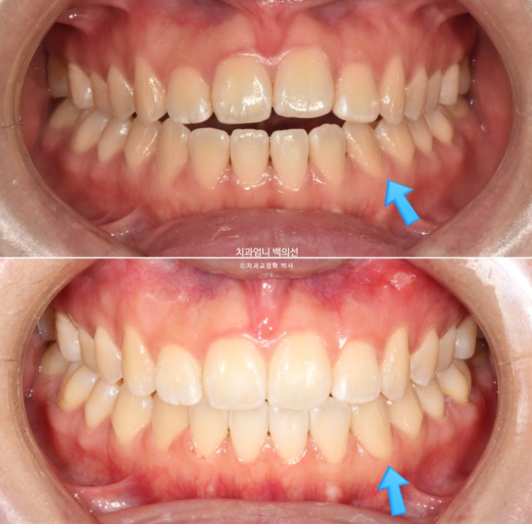 앞니 단기 부분교정 재교정 개방교합 교정 후기 관련 이미지 12