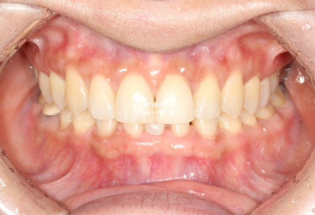 해외거주 앞니 선천적 결손 과개교합 인비절라인 라이트 브릿지 치료 관련 이미지 13