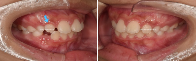 A Child’s Protruding Teeth Correction Review: Difficulty Closing the Lips image 3