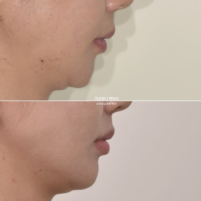 옥니 역교정 재교정 무턱 교정 치료기간 1년 10개월 관련 이미지 19