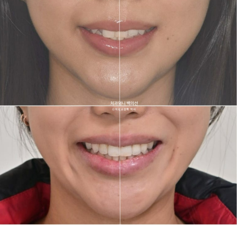 인비절라인 비발치 덧니 교정 반대교합 치료 후기 관련 이미지 19