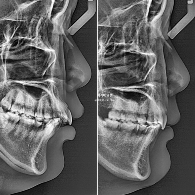 돌출입 덧니 발치 교정 인비절라인 교정 후기 관련 이미지 30