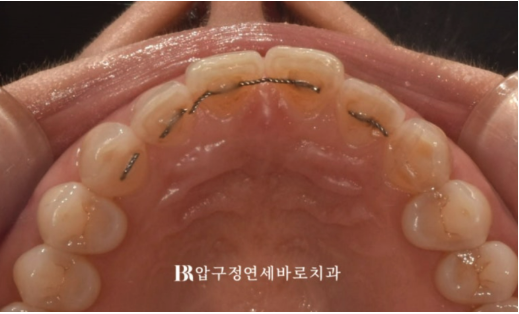 Laminate Veneers in Your 50s: Is It Possible Without Shaving Down the Teeth? | No-Prep Laminate Veneers + Real Case of Front Tooth Partial Orthodontics image 3