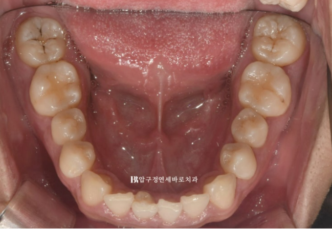 Can Invisalign Lite Correct Deep Bite and the Occlusal Plane? | A Real Case With 14 Aligners Over 4 Months image 4