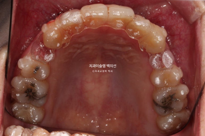 돌출입 인비절라인 발치교정 거미스마일 잇몸미소 잇몸돌출 입술부전증 무턱 재교정 관련 이미지 8