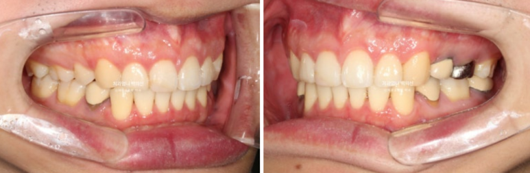 돌출입 발치 교정 인비절라인 후기 미니스크류 관련 이미지 16