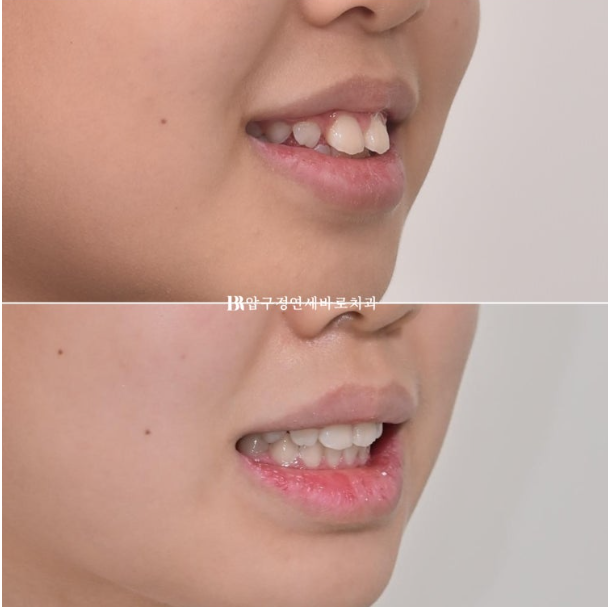 A Child’s Protruding Teeth Correction Review: Difficulty Closing the Lips image 16