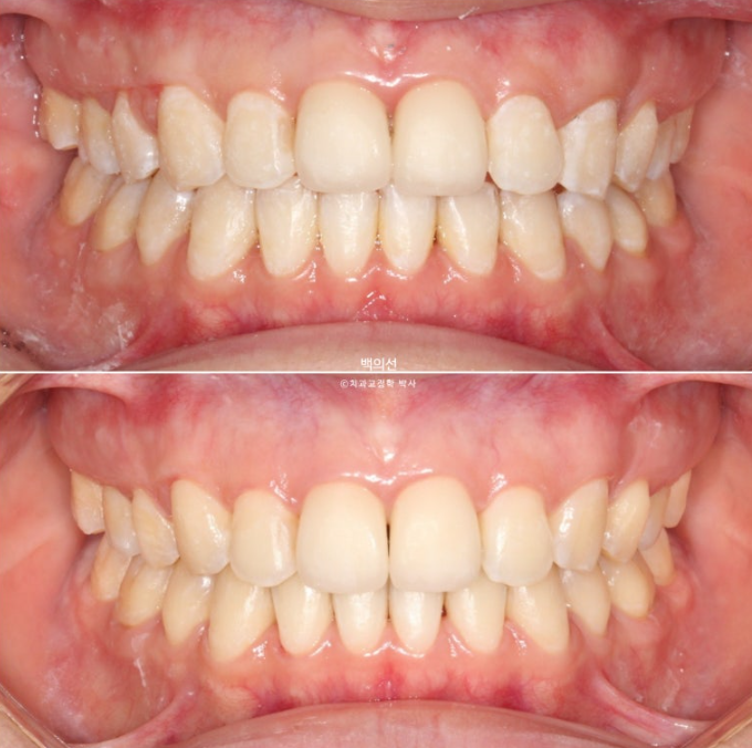 클리피씨 교정에서 인비절라인 변경 마무리 인비절라인 라이트 치료기간 4개월 관련 이미지 12