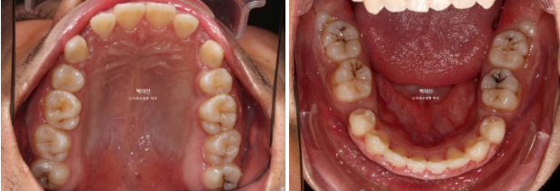 거미스마일 잇몸미소 발치 돌출입 과개교합 교정 후기 관련 이미지 4
