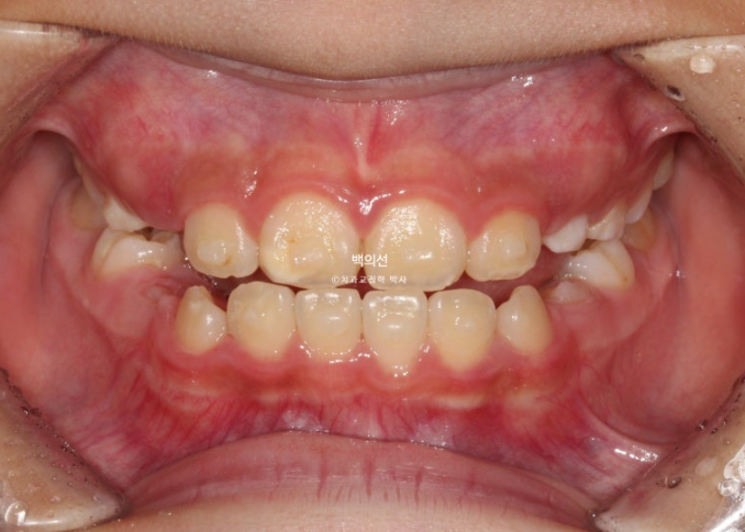 소아 비대칭 교정 인비절라인 퍼스트 재제작 1회 MA 치료 관련 이미지 8