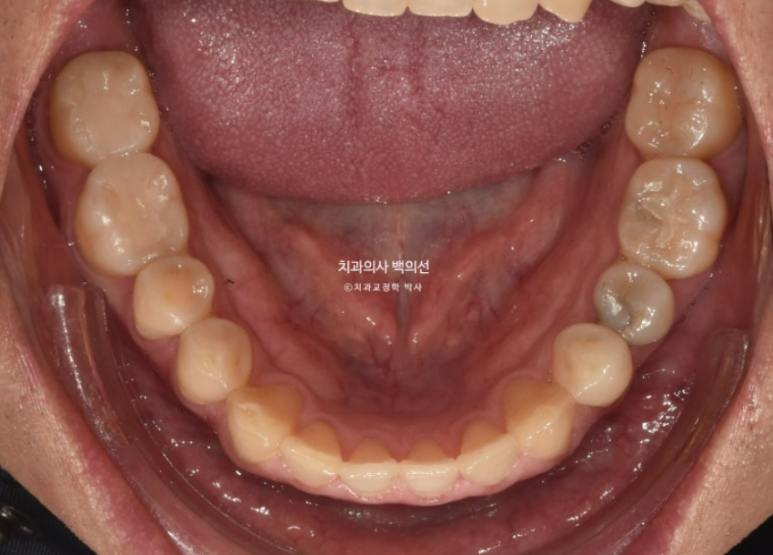 40대 인비절라인 비수술 비발치 주걱턱 비대칭 교정 관련 이미지 5