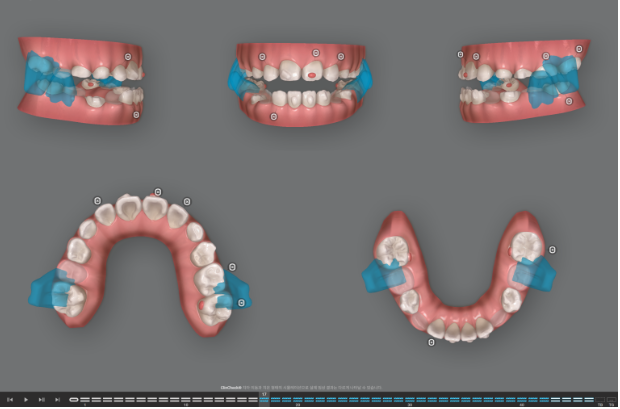 어린이 비대칭 반대교합 주걱턱 인비절라인 퍼스트 프리올소 성장 교정 관련 이미지 19