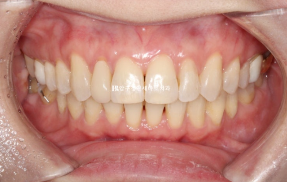 40대 인비절라인 라이트 가위교합? 관련 이미지 13