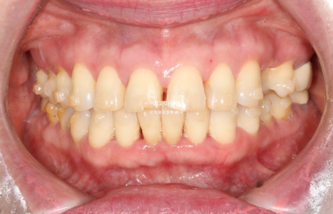 50대 치아교정 돌출 치아벌어짐 중년교정 관련 이미지 8