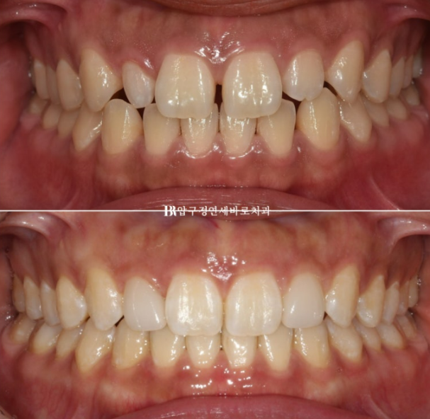 왜소치 인비절라인 라이트 교정 / 무삭제 라미네이트 젤라미 관련 이미지 3