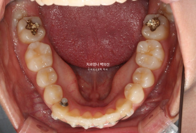 앞니 부분 교정 토끼이빨 덧니교정 ? 관련 이미지 8