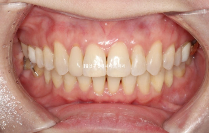 Invisalign Lite for Orthodontic Treatment in Your 40s: Crossbite and Protrusive Mouth Correction image 12