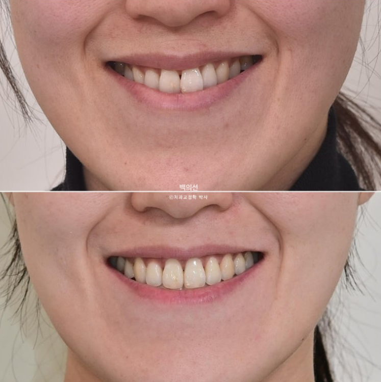 30대 비수술 비발치 주걱턱 부정교합 인비절라인 교정 관련 이미지 15