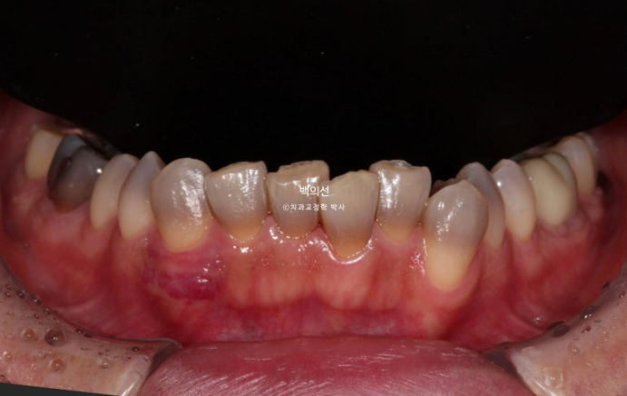 Treatment Review: No-Prep Laminate for Tetracycline-Stained Teeth image 4