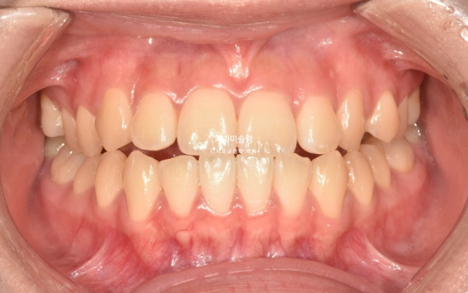 비발치 비수술 주걱턱 반대교합 재교정 치료 관련 이미지 2