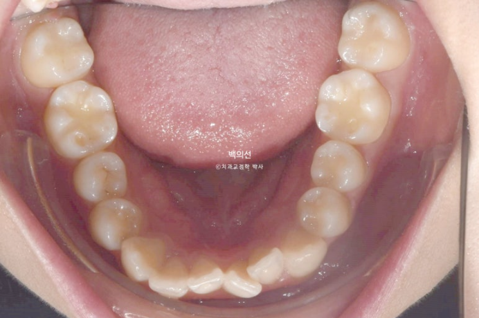비발치 덧니교정 인비절라인 교정 사랑니 이용 교정 관련 이미지 5