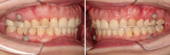 비발치 덧니 교정 인비절라인 과개교합 교정 무삭제 라미네이트 치료 후기 관련 이미지 8