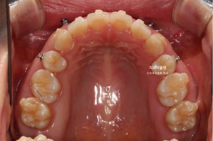 돌출입 덧니 발치 교정 인비절라인 교정 후기 관련 이미지 15