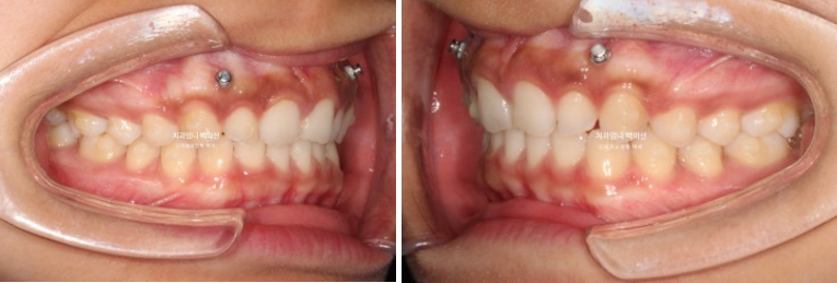 과개교합 옥니 거미스마일 교정 인비절라인 라이트 잇몸성형 후기 관련 이미지 8