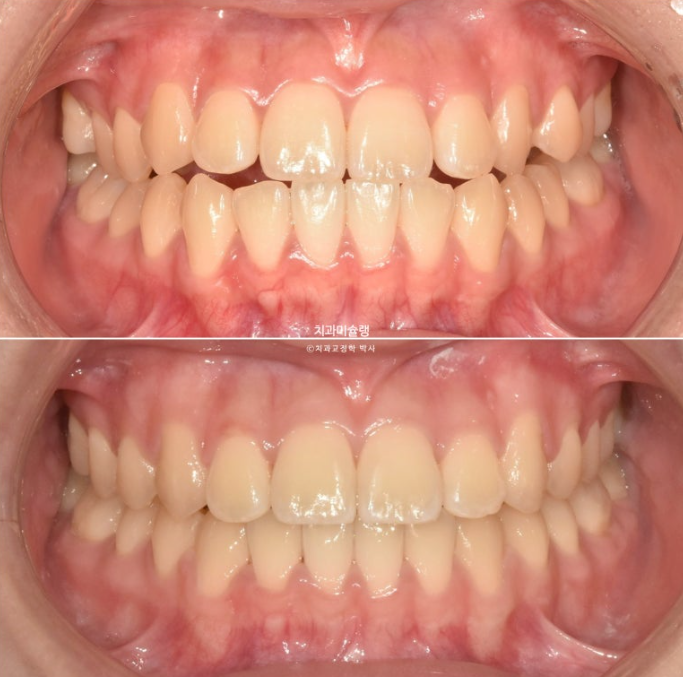 비발치 비수술 주걱턱 반대교합 재교정 치료 관련 이미지 13