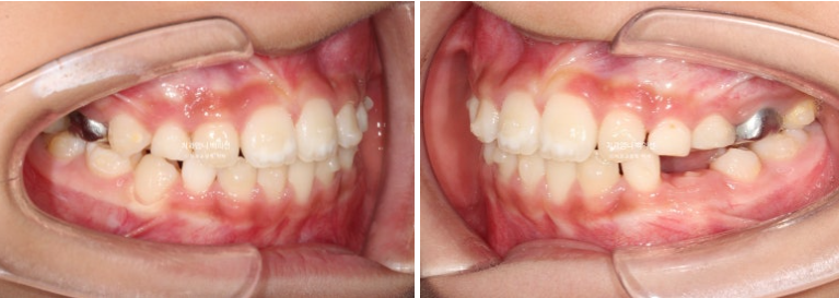 어린이 교정 인비절라인 퍼스트 비대칭 반대교합 어린이 성장 교정 관련 이미지 14