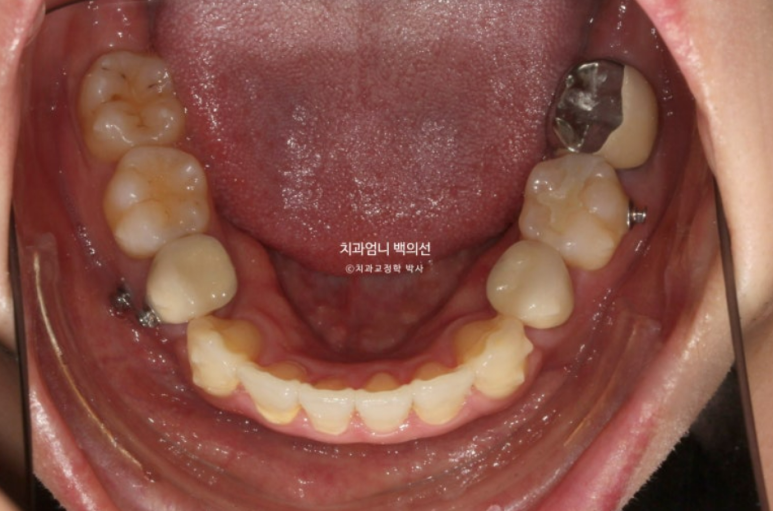 돌출입 발치 교정 인비절라인 후기 미니스크류 관련 이미지 11