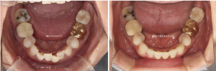 50대 치아교정 인비절라인 라이트 앞니교정 치료 후기 관련 이미지 12