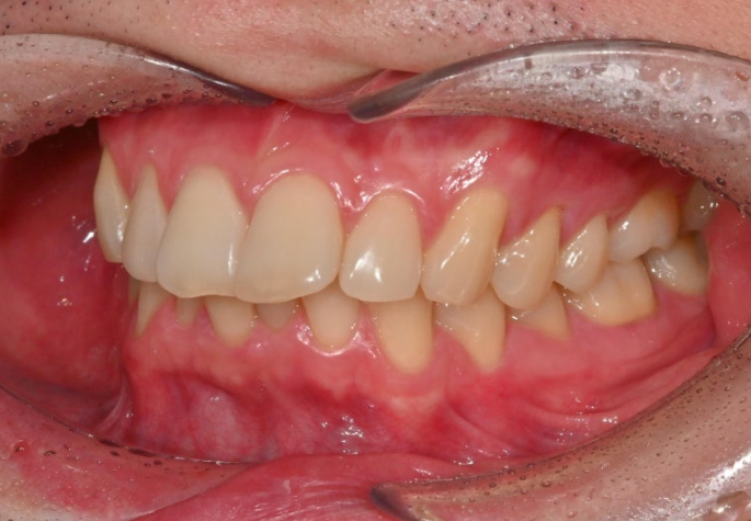 인비절라인 라이트 돌출 과개교합 중심선 교정 치간삭제 치료기간 관련 이미지 4