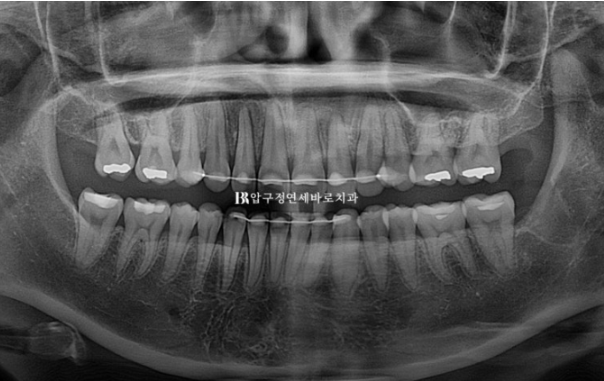 Can't Invisalign Move the Roots? An Actual Case of Extraction Treatment for Protruding Mouth at a Gangnam Orthodontic Clinic image 17