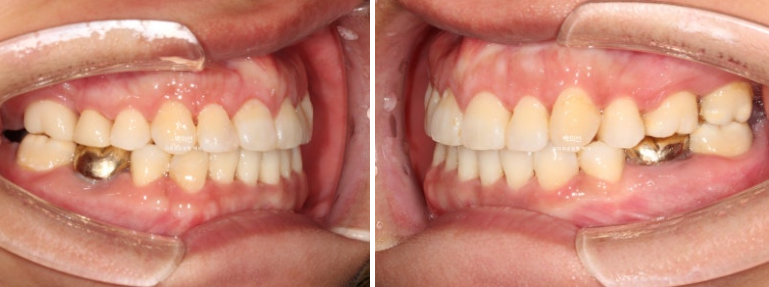 거미스마일 교정 돌출입 발치교정 입술부전 호두턱 치료기간 2년반 관련 이미지 17