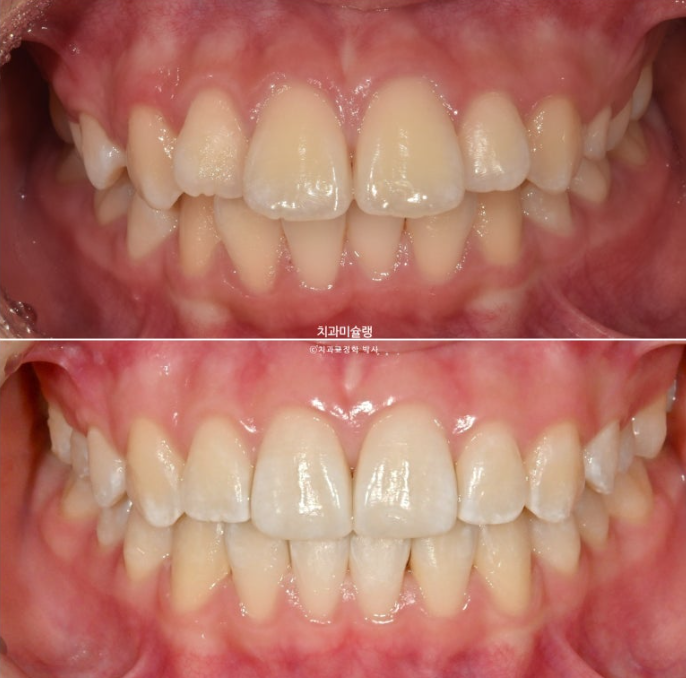 돌출입 비발치 어린이 교정 입술부전증 호두주름 호두턱 토끼이빨 인비절라인퍼스트 관련 이미지 18