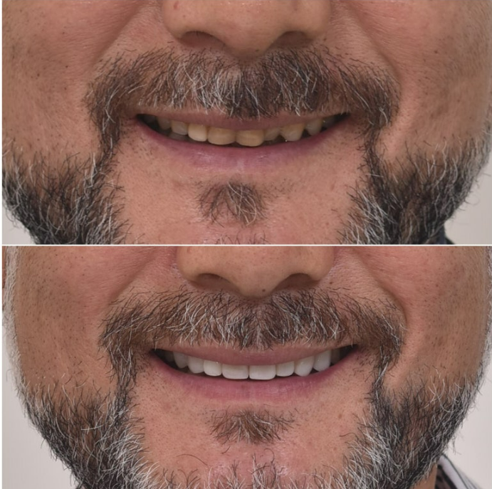 50대 중년교정 무삭제 라미네이트 중년 부분교정 후기 관련 이미지 12