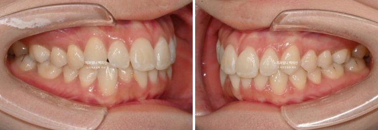 인비절라인 라이트 교정 앞니돌출 과개교합 덧니 교정 관련 이미지 4