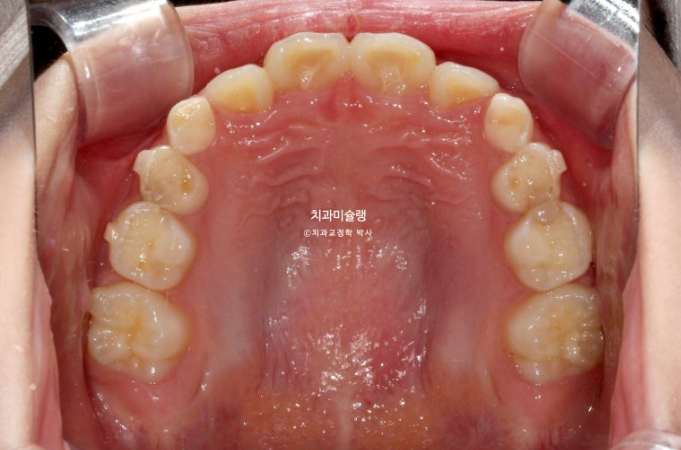 어린이 투명교정 인비절라인 퍼스트 과개교합 교정 후기 관련 이미지 10